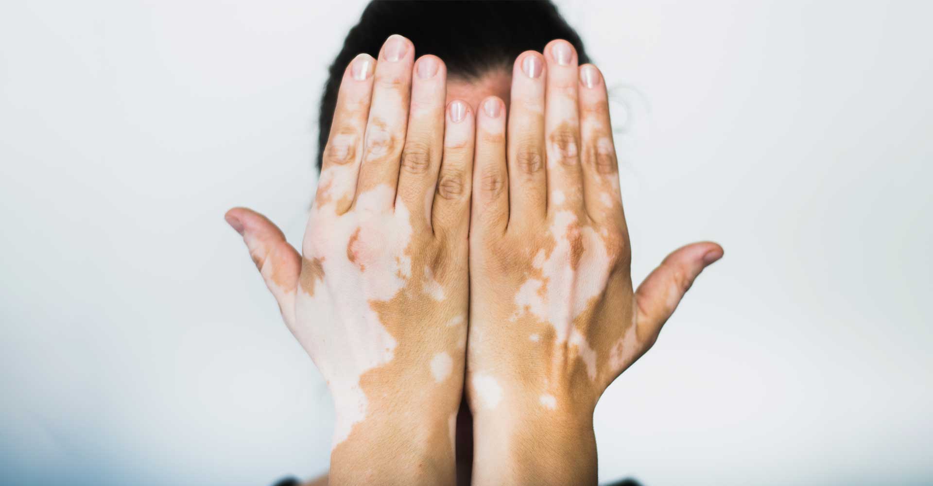 Vitiligo
