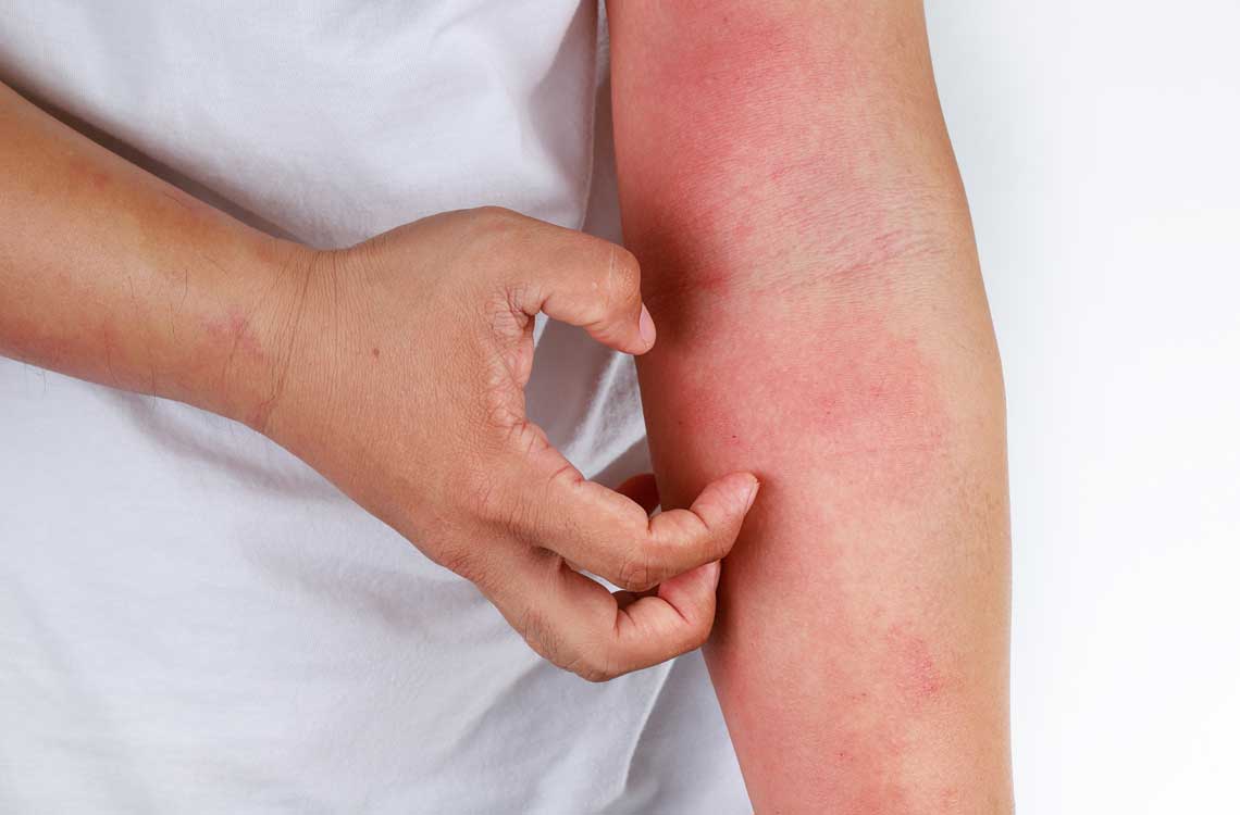 Dermatitis Atópica