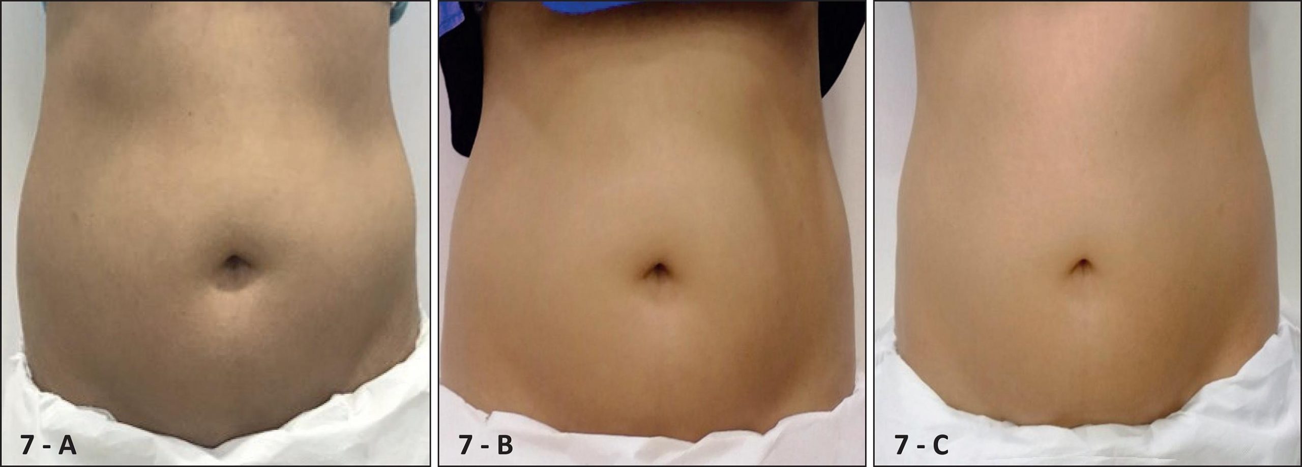 Antes y después MedContour 2