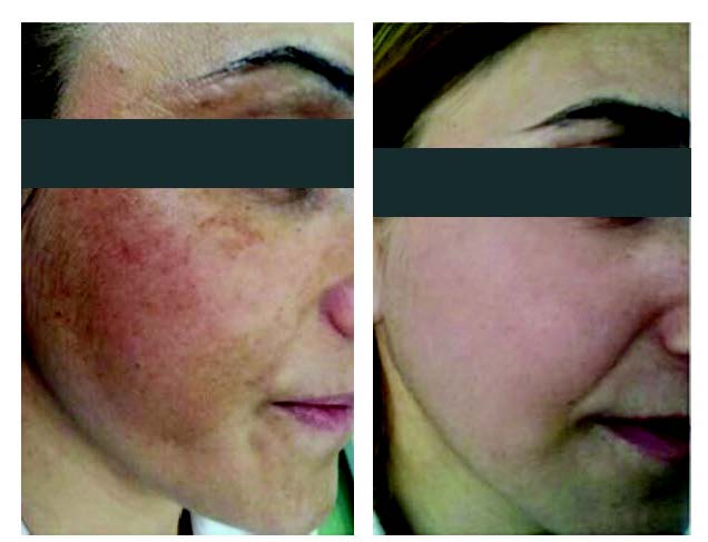 Melasma Antes y Después