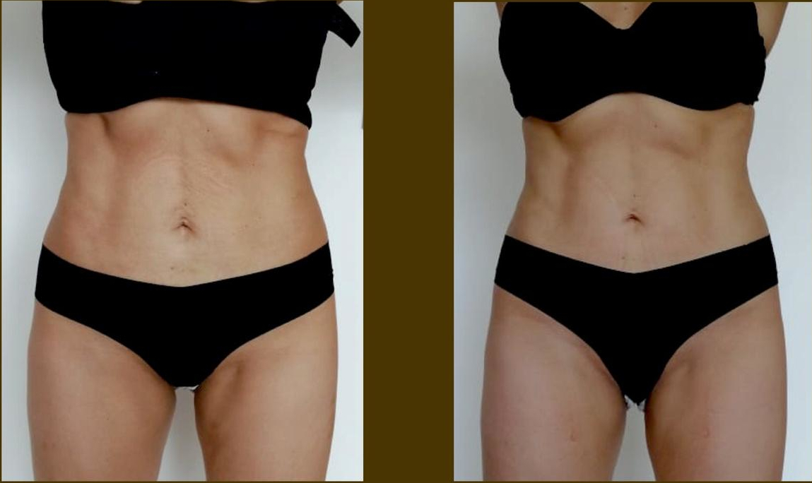 Antes y después HyperSculpt 2