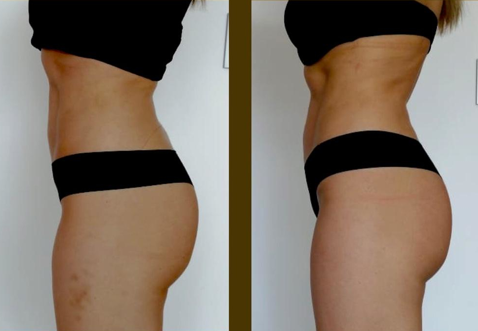 Antes y después HyperSculpt 1