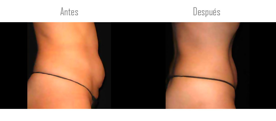Antes y después MedContour 1