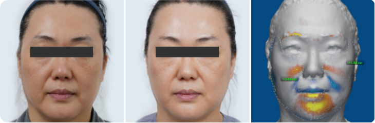 Resultados Ultraformer MPT 1